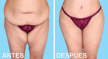 Tummy Tuck Tummy Tuck